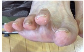 巻き爪ケア3カ月後の足爪写真
